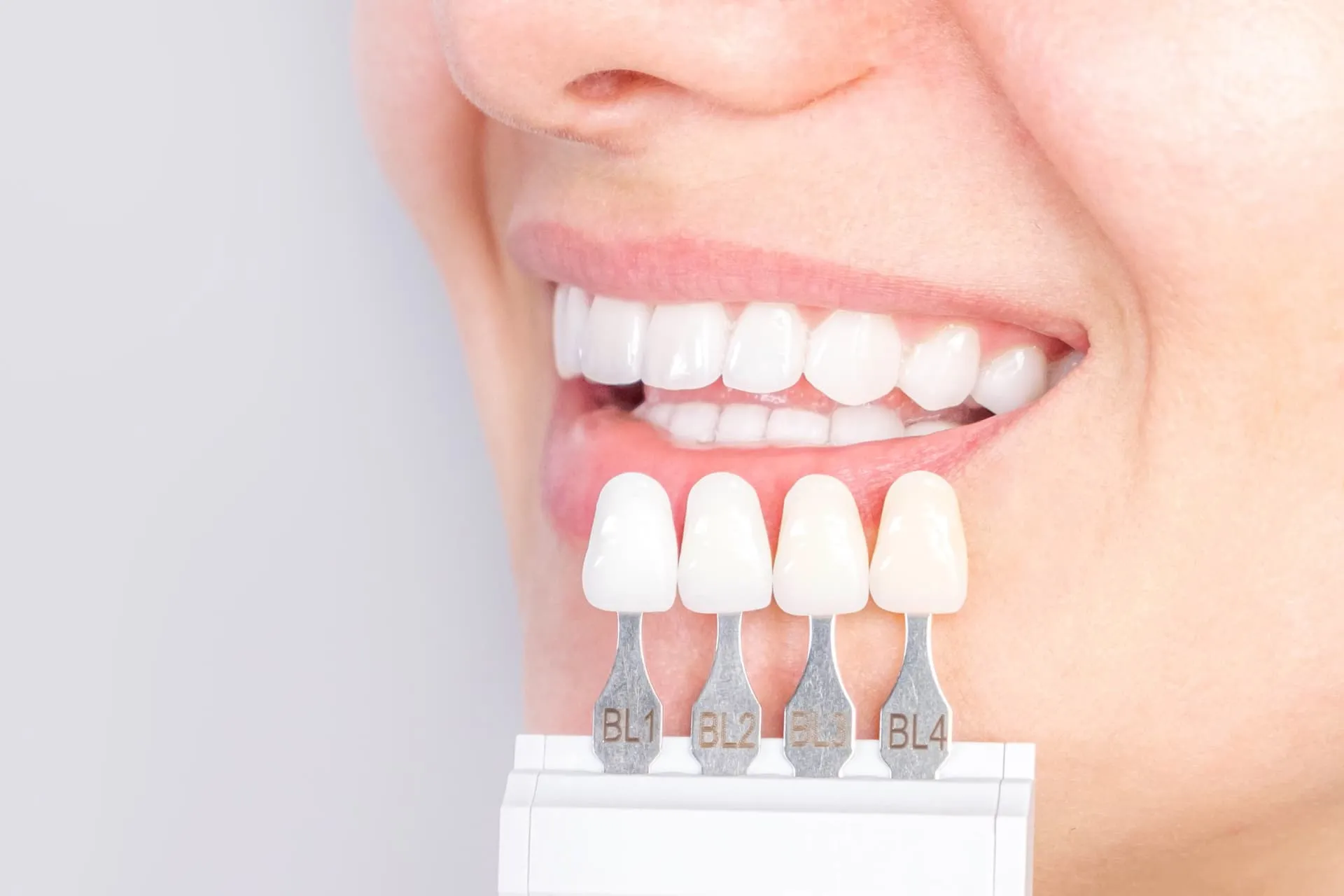 Sonrisa comparada con una guía de tonos de blanqueamiento dental